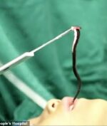 Dokter Berhasil Keluarkan Lintah dari Mulut Seorang Bocah, Kok Bisa?
