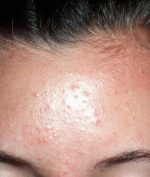 fungal acne